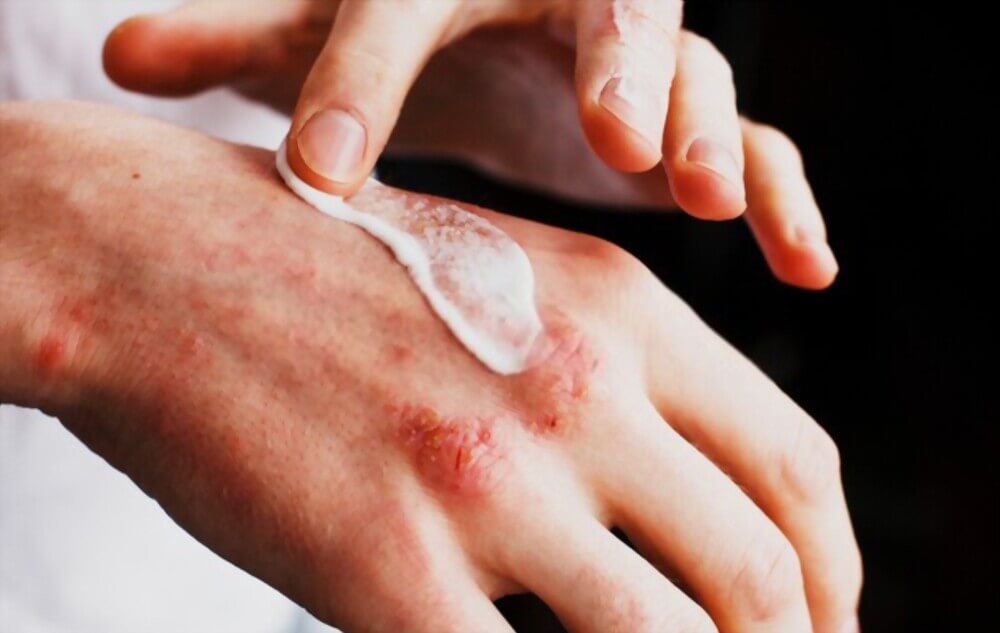 Treat Eczema