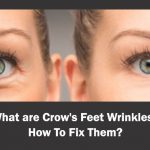 Crows Feet Wrinkles