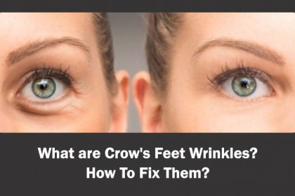 Crows Feet Wrinkles