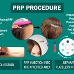 Platelet Rich Plasma Therapy(PRP)